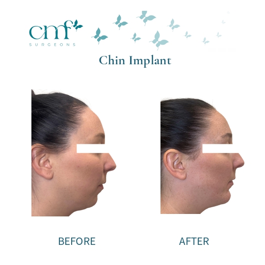 Before & After | Chin Implants