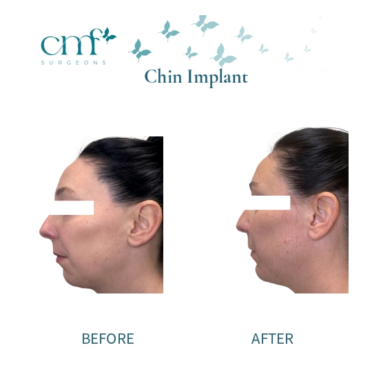Before & After | Chin Implants