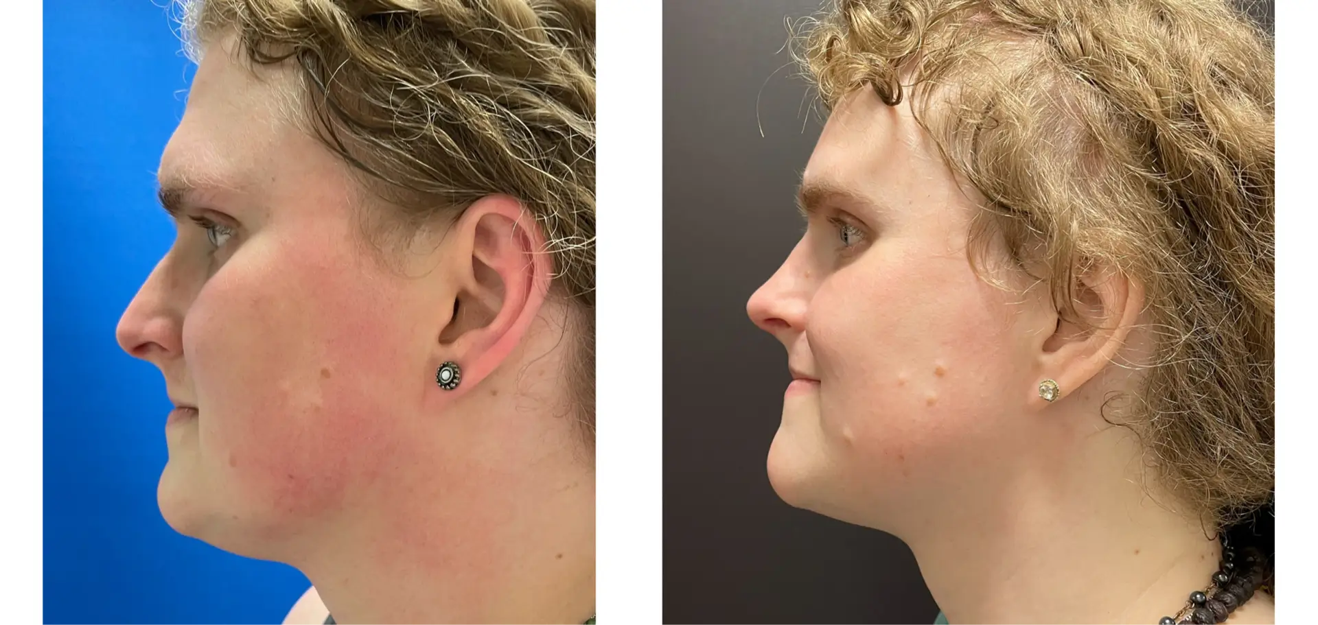 Facial Feminization - Surgery Before & After