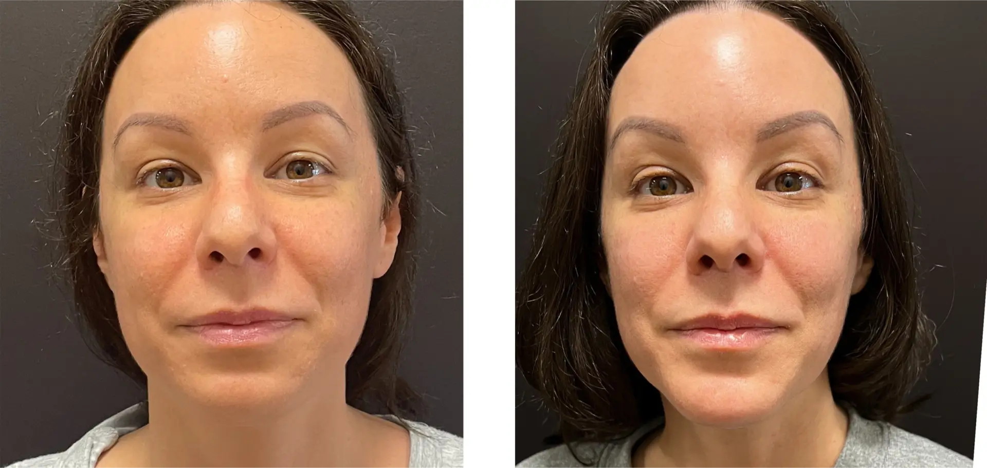 Genioplasty - Before & After
